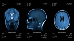 MRI scan of a concussion